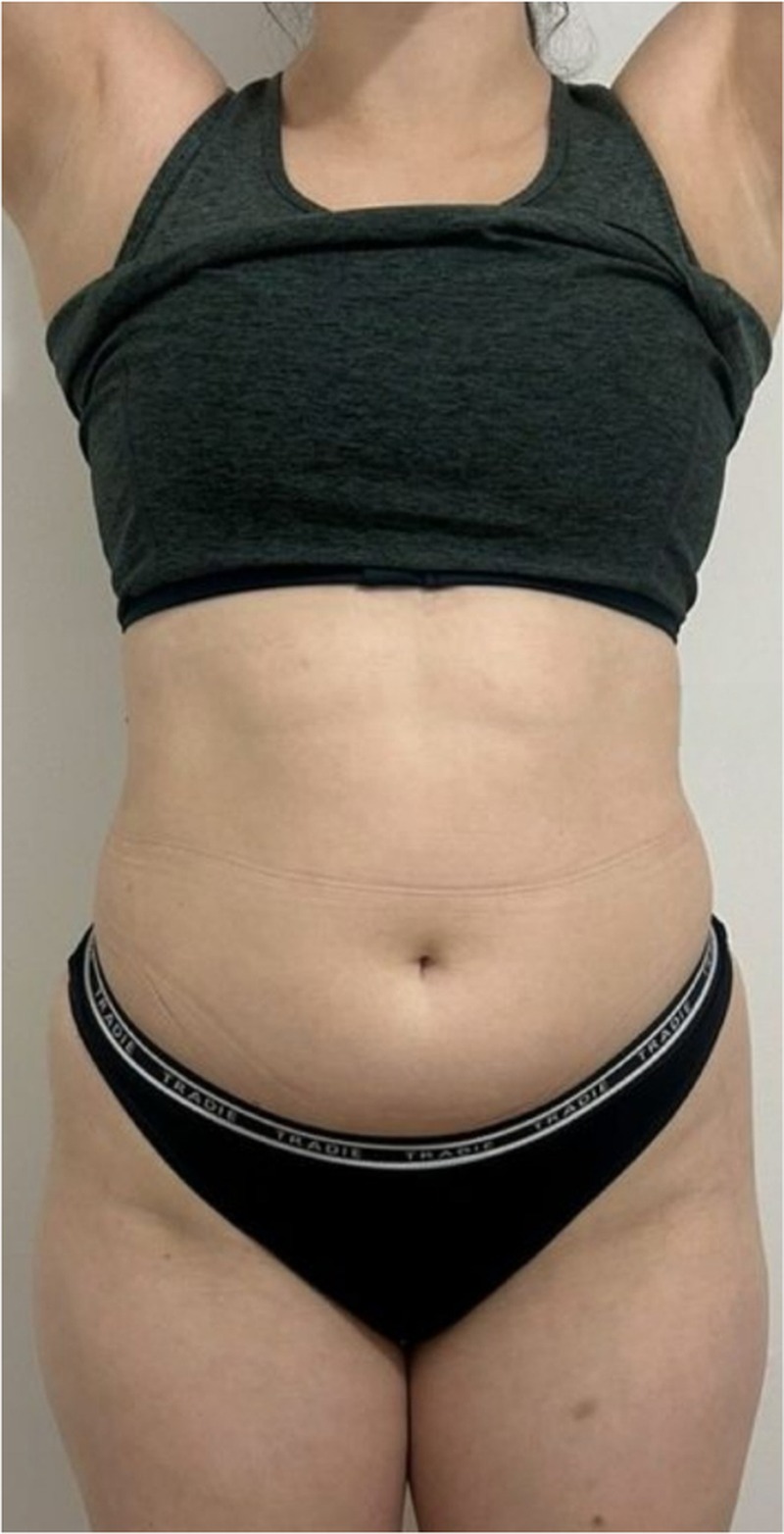 Client's abdomen before 360 degree Fat Freezing treatment at Portland Body Clinic